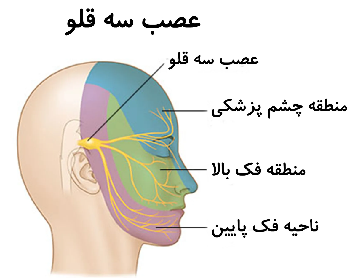 نورالژی عصب سه قلو
